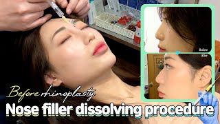 How to Dissolve Nose Filler Before hooked nose rhinoplasty or nose job [upl. by Waldron106]