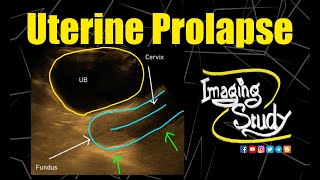 Uterine Prolapse  Ultrasound  Case 223 [upl. by Isiahi]