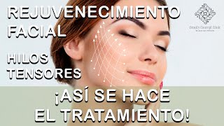 👍🏻 Así se realiza el procedimiento de Hilos Tensores para rejuvenecimiento facial [upl. by Ahseinet622]