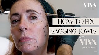 HOW TO FIX SAGGING JOWLS  DERMAL FILLER INJECTIONS VIVA 2023 [upl. by Garap]