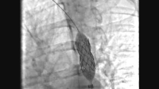Коарктация аорты стентирование этапы операции и техника эндоваскулярной коррекции [upl. by Sadoc]