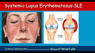 Lecture 12 Systemic lupus erythematosus SLE [upl. by Ilenna779]