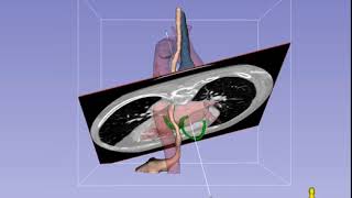 MidEsophageal 4Chamber Imaging Plane in TEE  Standard View [upl. by Launame924]