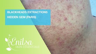 Blackheads Extraction Hidden Gem Paris [upl. by Ahtiek735]