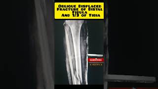 DISPLACED OBLIQUE FRACTURE OF DISTAL FIBULA AND I3 OF TIBIAL BONE fracture viralshorts [upl. by Haleemaj]