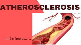 Atherosclerosis in 2 minutes [upl. by Ariik174]