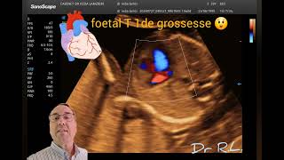 ✅️ Echo T1 de grossesse 🤷 quoi de neuf 🤔 [upl. by Anegal]