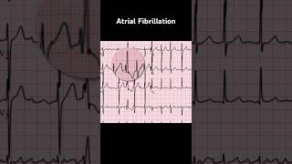 Atrial Fibrillation ECG Ashman phenomenon [upl. by Notnirt]