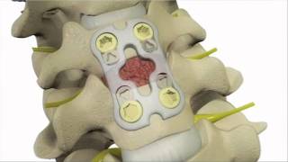 Anterior Cervical Discectomy and Fusion  DePuy Videos [upl. by Vanhook]