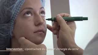 Chirurgie des cernes  Lipostructure du cerne [upl. by Sofie]