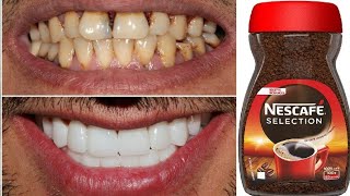 teeth whitening at home in 2 minutes  how to naturally whiten your yellow teeth [upl. by Noek]