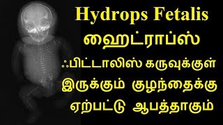 Hydrops Fetalis ஹைட்ராப்ஸ் ஃபிட்டாலிஸ் கருவுக்குள் இருக்கும் குழந்தைக்கு ஏற்பட்டு ஆபத்தாகும் [upl. by Nonnahs]