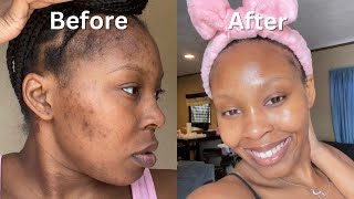 How I Cleared My Acne  Dark Spots  Hyperpigmentation for good in 1 month NO ACCUTANE VIDEO PROOF [upl. by Abbotson]