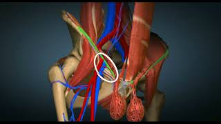 3 Autres points faibles de la paroi abdominale [upl. by Wendel40]