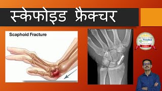 Scaphoid Fracture  All you want to know Hindi स्केफोइड फ्रैक्चर [upl. by Milburn]