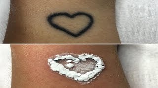 How To Remove Tattoo Naturally At Home Without Laser [upl. by Romelle]