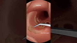 asmr ear wax cleaning treatmentear treatment asmr ear piercing treatment earmachine [upl. by Cort744]