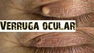 Como remover VERRUGAS oculares [upl. by Laurena43]