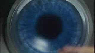 LasikPlus Intralase® Bladeless LASIK Procedure AllLaser Lasik [upl. by Iviv]