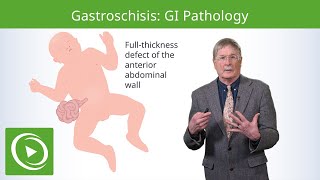 Gastroschisis GI Pathology  Epidemiology Pathophysiology Diagnosis amp Treatment [upl. by Nivlad401]