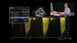 LowFlow Aortic Stenosis [upl. by Kcinemod]