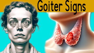 Goiter explained under 3 minutes Causes Symptoms Treatment [upl. by Lurleen]