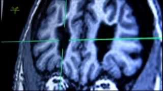 Transorbit lobotomy and MRI examination of living lobotomized patients brain [upl. by Cornelius]