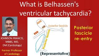 What is Belhassens ventricular tachycardia [upl. by Aitel]