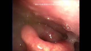 喉部杓狀軟骨間的肉芽腫 interarytenoid granuloma [upl. by Catima]