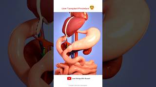 Liver transplant Procedure Animation Video [upl. by Joly]