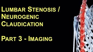 Lumbar Stenosis  Neurogenic Claudication  Imaging  Zeeshan Sardar SpineScoliosis Surgeon [upl. by Sloane]