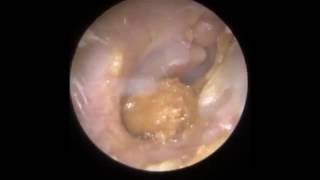 Ear Wax Removal Leicester  Mr Neel Raithatha The Hear Clinic [upl. by Kcirdef]