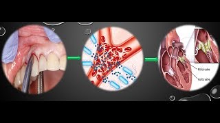 Infective Endocarditis and its dental consideration [upl. by Burr]