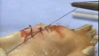 Introduction to Periodontal Surgery Techniques Initial Incisions and Suturing [upl. by Yelkcub]