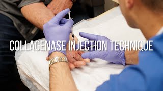 Collagenase Injection Technique for Dupuytrens Contracture [upl. by Atinele]