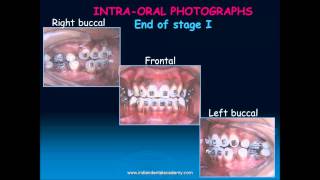 beggs technique part  orthodontic courses by Indian dental academy [upl. by Nera]