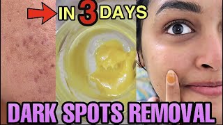 Remove DARK SPOTS NATURALLY in 3 Days 😍 Hyperpigmentation Acne Scars Brown Spots [upl. by Clarance]