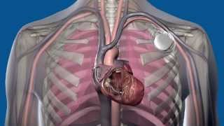 What is fluid monitoring for heart failure [upl. by Llerrot]