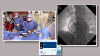 Part 5B of 6 Cryoballoon ablation for Atrial Fibrillation by Wilber Su [upl. by Acirea853]