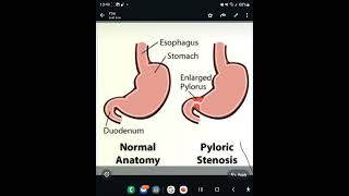 Video Pyloric stenosis [upl. by Akela]