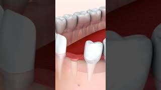 Dental implants of lower canine teeth procedure dentist implants prosthesis jawbone tothebone [upl. by Leik]