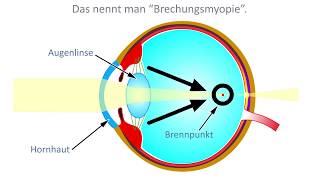 Kurzsichtigkeit Myopie Defintion Ursachen und Wirkung [upl. by Holmun]