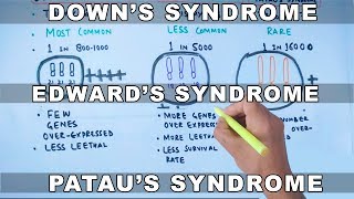 Trisomy  Downs vs Edwards vs Pataus Syndrome [upl. by Clayborn]