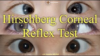 Hirschberg Corneal Reflex Test Principles and Procedure [upl. by Ahsac]