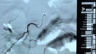 Spinal ArterAngio 033012mp4 [upl. by Hairaza]