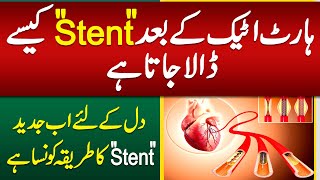 Heart Stent Procedure  Heart Stent Kaise Dalte Hain  Heart Attack Stent Procedure [upl. by Ydak]