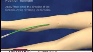 Scanlan Vascular Tunneling System [upl. by Aracal]