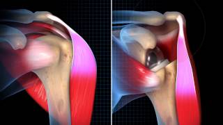 Biomechanical Summary of Reverse Shoulder Arthroplasty [upl. by Eimmit]