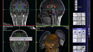 DTI  MRI Siemens diffusion tensor imaging [upl. by Bettencourt]