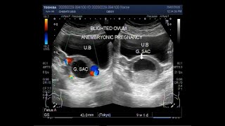 Ultrasound Video showing Anembryonic pregnancy also called Blighted ovum [upl. by Soelch]